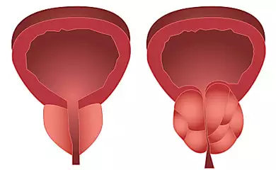 Enlarged Prostate 101: Understanding Symptoms, Supportive Therapy, and Prostate Health Tips