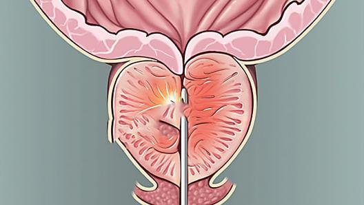 Enlarged Prostate 101: Understanding Symptoms, Supportive Therapy, and Prostate Health Tips 1 | Senstantly™ Enlarged Prostate 101: Understanding Symptoms, Supportive Therapy, and Prostate Health Tips
