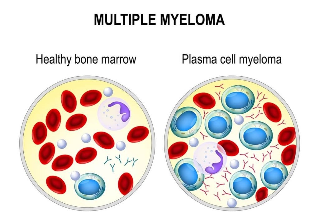 Understanding Multiple Myeloma and Its Early Signs (Unveiling the Silent Threat) 1 | Senstantly™ Understanding Multiple Myeloma and Its Early Signs